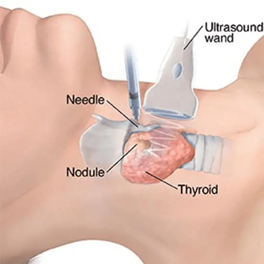 Thyroid FNAC recovery image showing clean biopsy site and proper aftercare