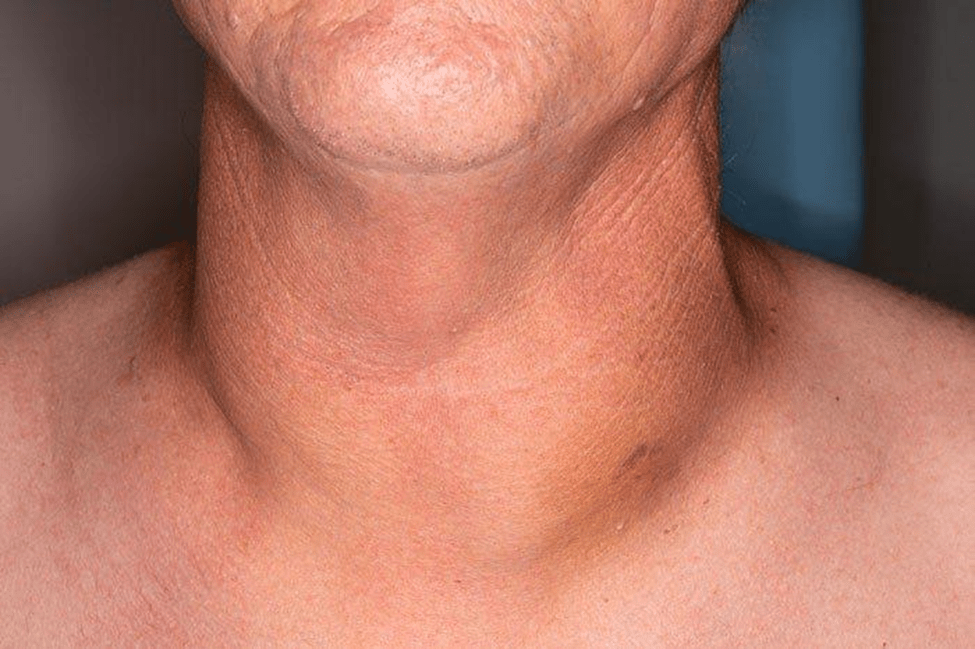 Thyroid FNAC biopsy aftercare showing mild swelling and proper healing process