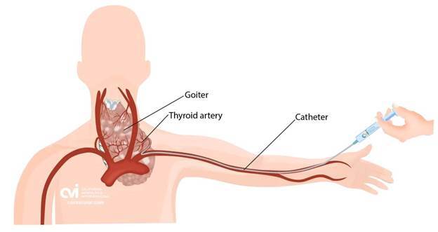 Clinical setting image of thyroid FNAC post procedure care and recovery guidance