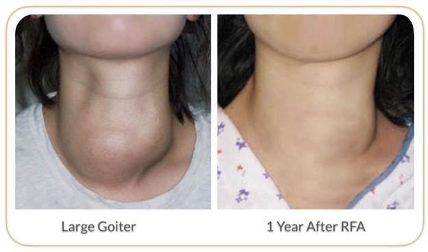 Patient following post procedure instructions for thyroid FNAC with minimal discomfort