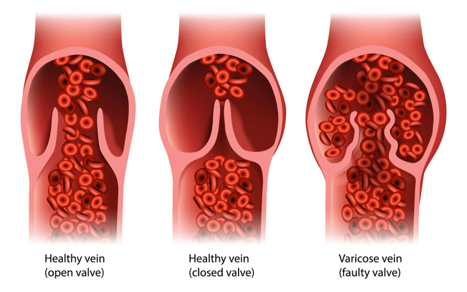 Varicose vein symptoms and treatment in Chennai clinic