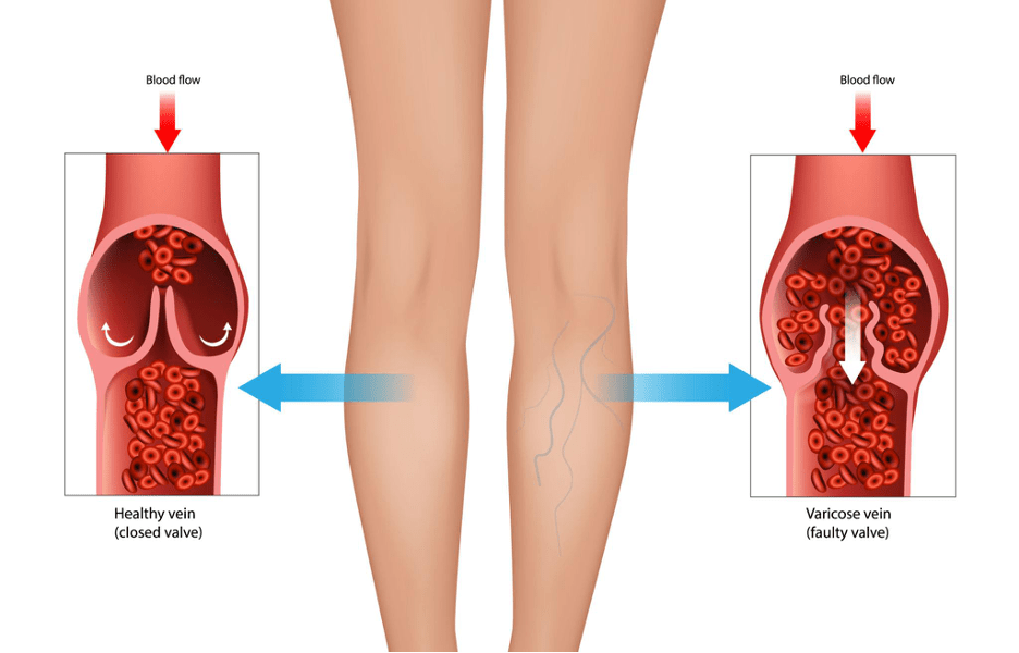 Before and after varicose veins treatment in Chennai