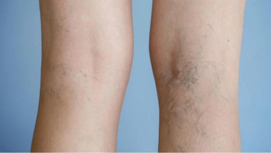 RFA treatment for varicose veins Chennai hospital