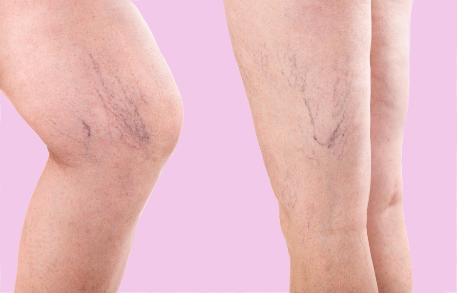Signs of varicose veins in legs Chennai patients