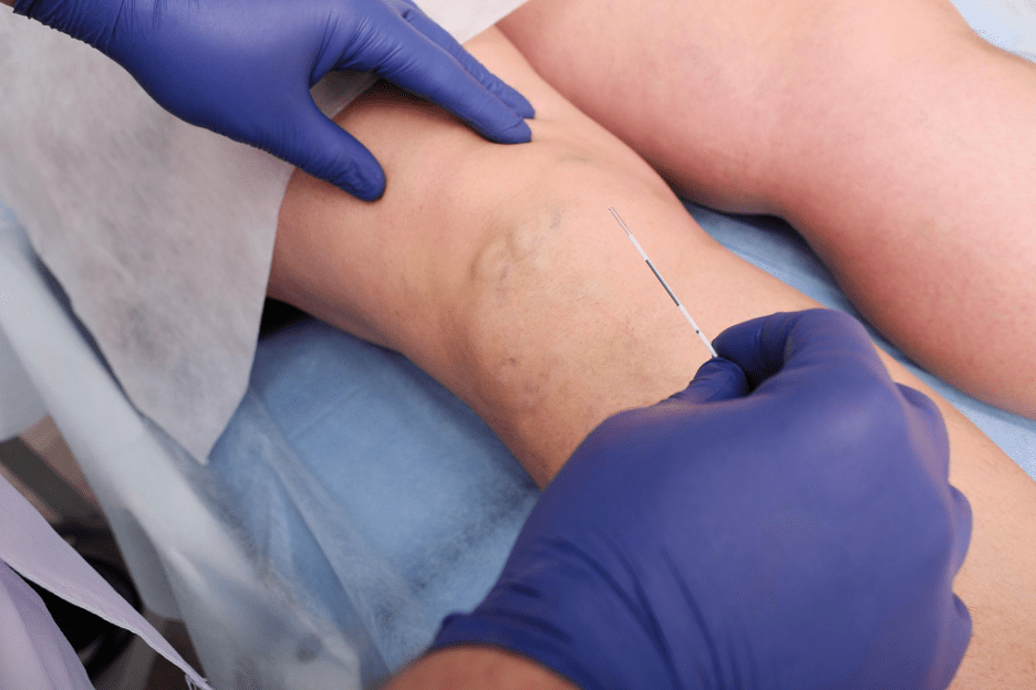 Doctor performing varicose veins treatment in Chennai