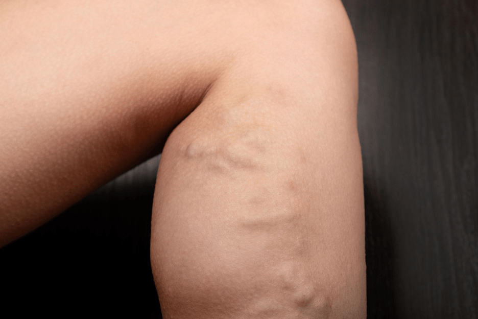 Doppler ultrasound for varicose veins diagnosis Chennai