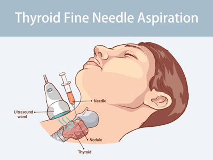 Clinical setting image of thyroid FNAC post procedure care and recovery guidance