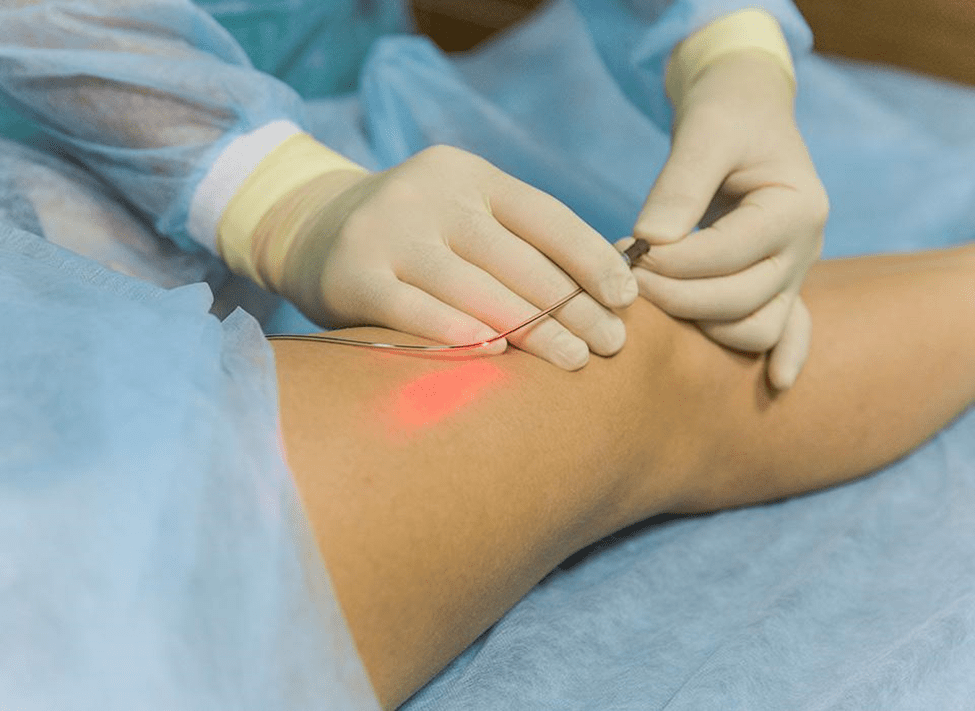 Endovenous Laser Treatment EVLT used for Varicose Vein Treatment Without Surgery close-up medical shot