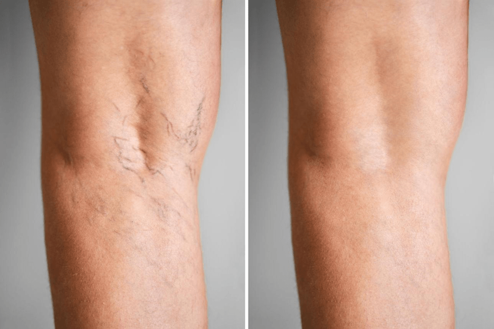 Minimally invasive Varicose Vein Treatment Without Surgery with laser catheter and ultrasound guidance
