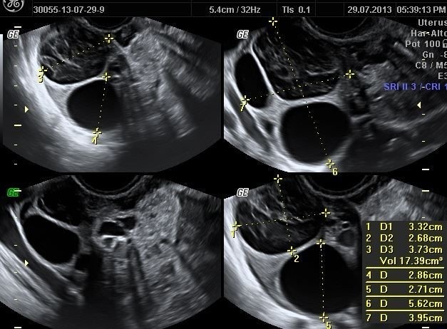 Non-surgical uterine fibroid embolization (UFE) treatment process infographic showing faster recovery and uterus-preserving care in Chennai.

