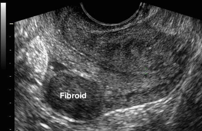 Doctor explaining non-surgical UFE treatment for uterine fibroids in Chennai with recovery and benefits infographic.