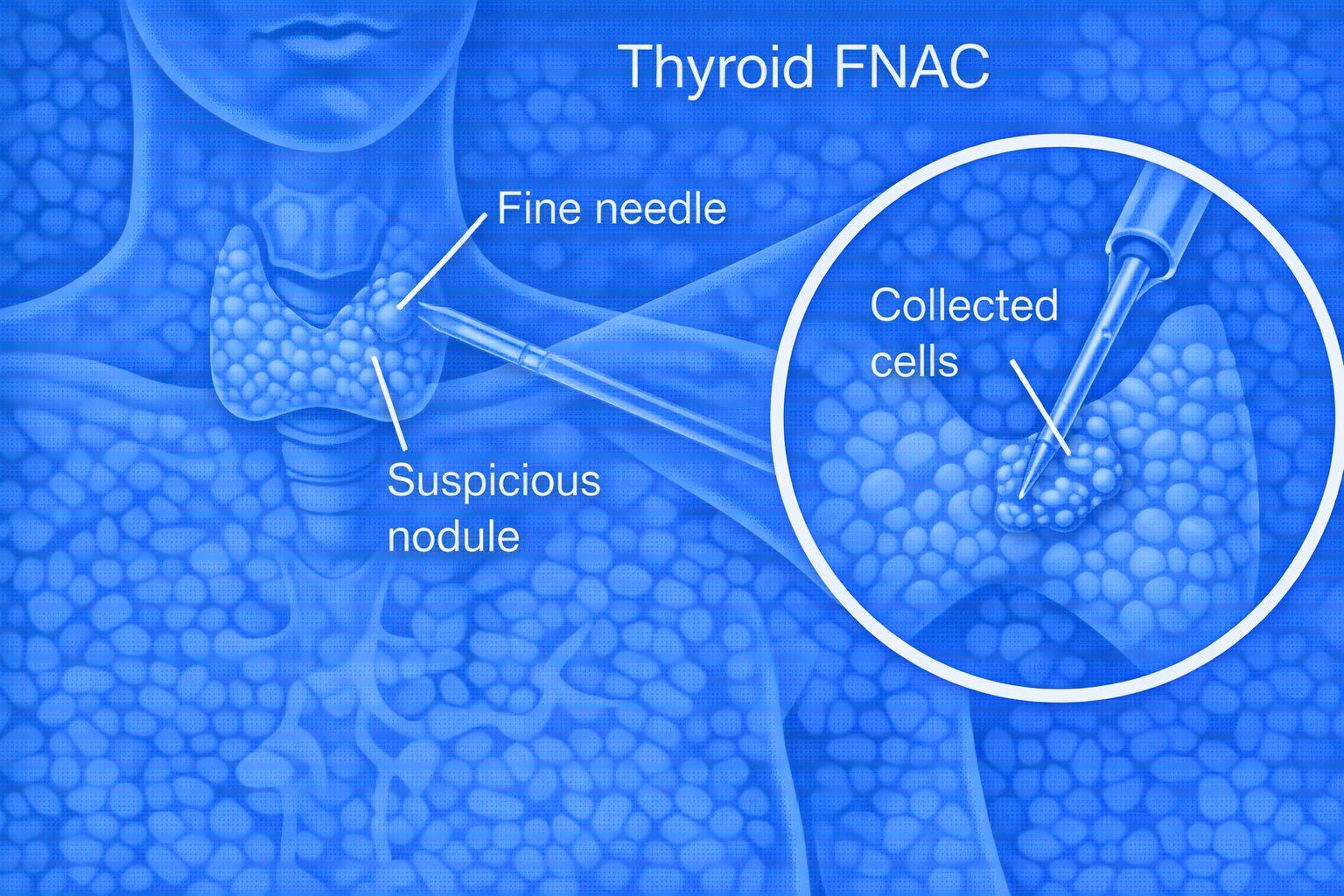 Thyroid FNAC