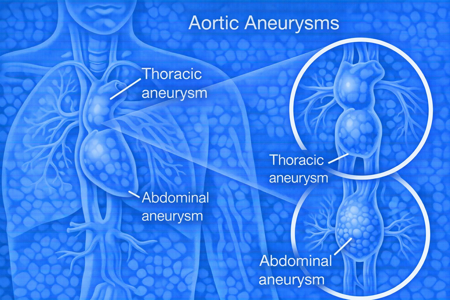 aortic aneurysm treatment chennai