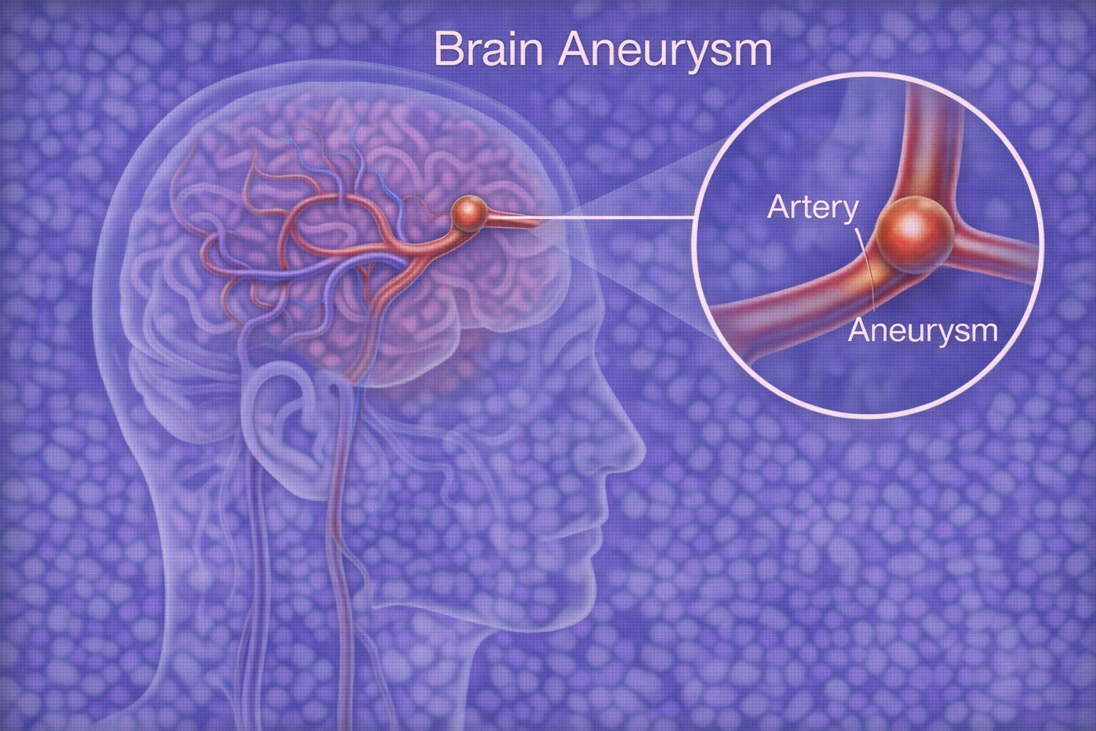 Brain Aneurysm