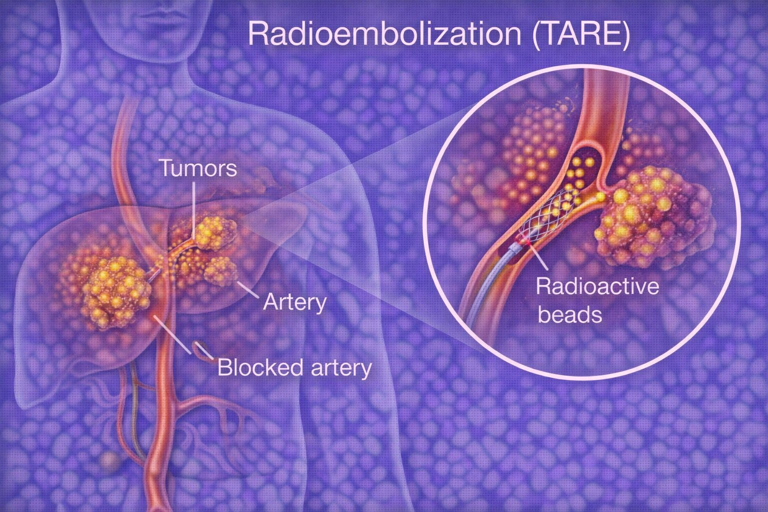 Radioembolization (TARE)