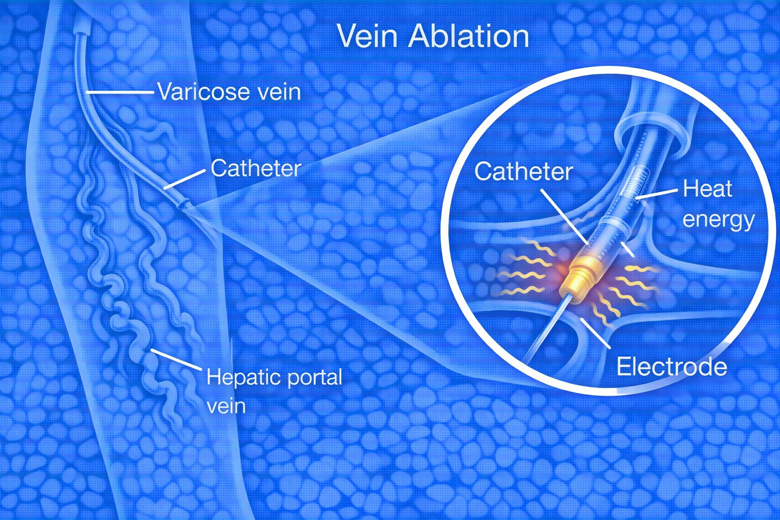 Varicose Vein Treatment Chennai – Procedure & Options