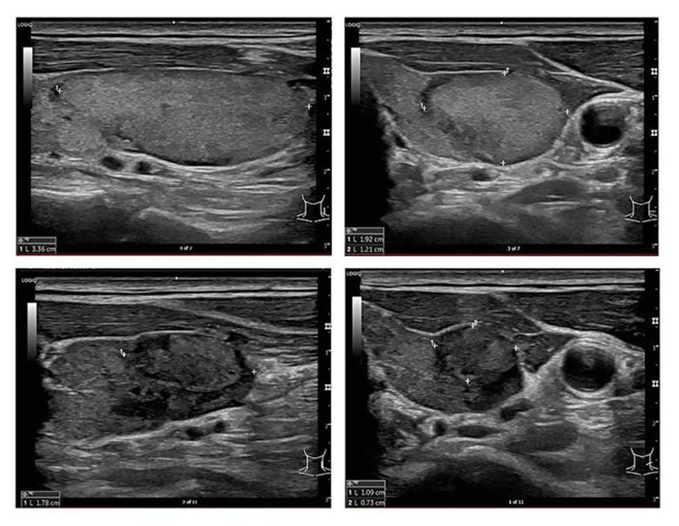 Clinical setting image of thyroid FNAC post procedure care and recovery guidance